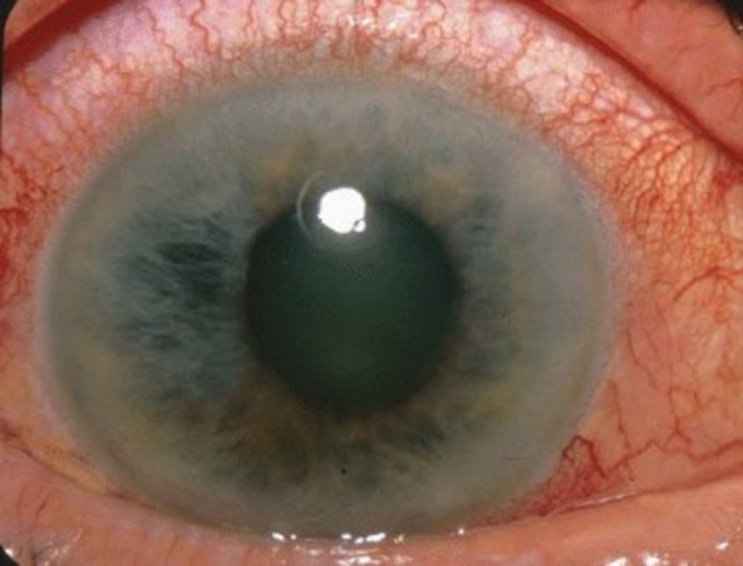 Narrow-Angle Glaucoma