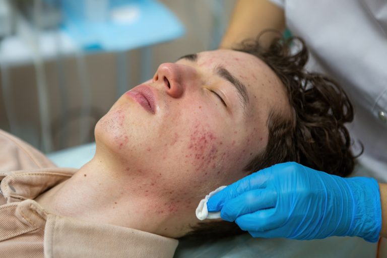 3 Main Types of Acne Scars and how to Treat them all
