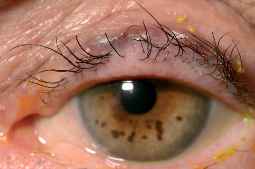 ingrown eyelash