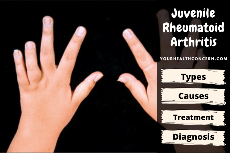 Juvenile Rheumatoid Arthritis Basics (for Kids & teens)