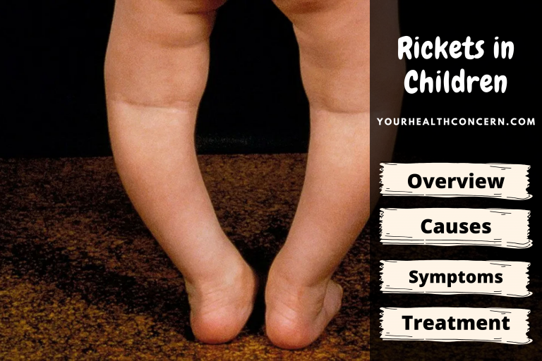 Rickets in Children: Definition, Causes, Symptoms, Treatment